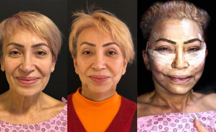 57 yaşlı Nahidə Orucovanın plastik əməliyyatdan sonrakı halı